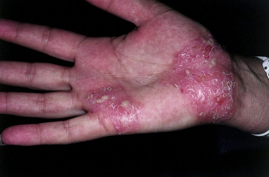 Worsening of psoriasis on the hands