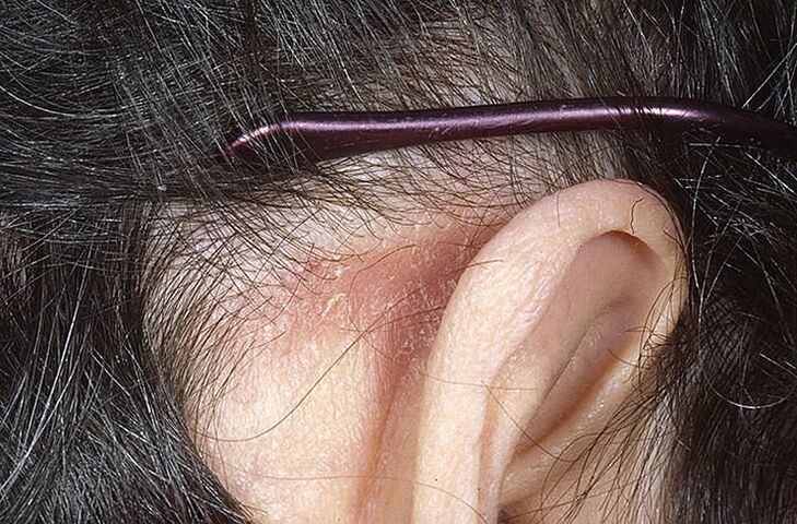 Psoriasis plaque behind the ear