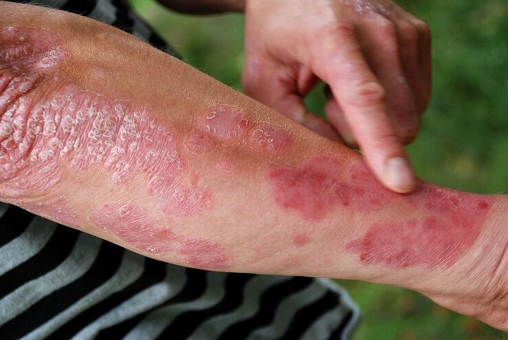 Psoriasis plaques on arm