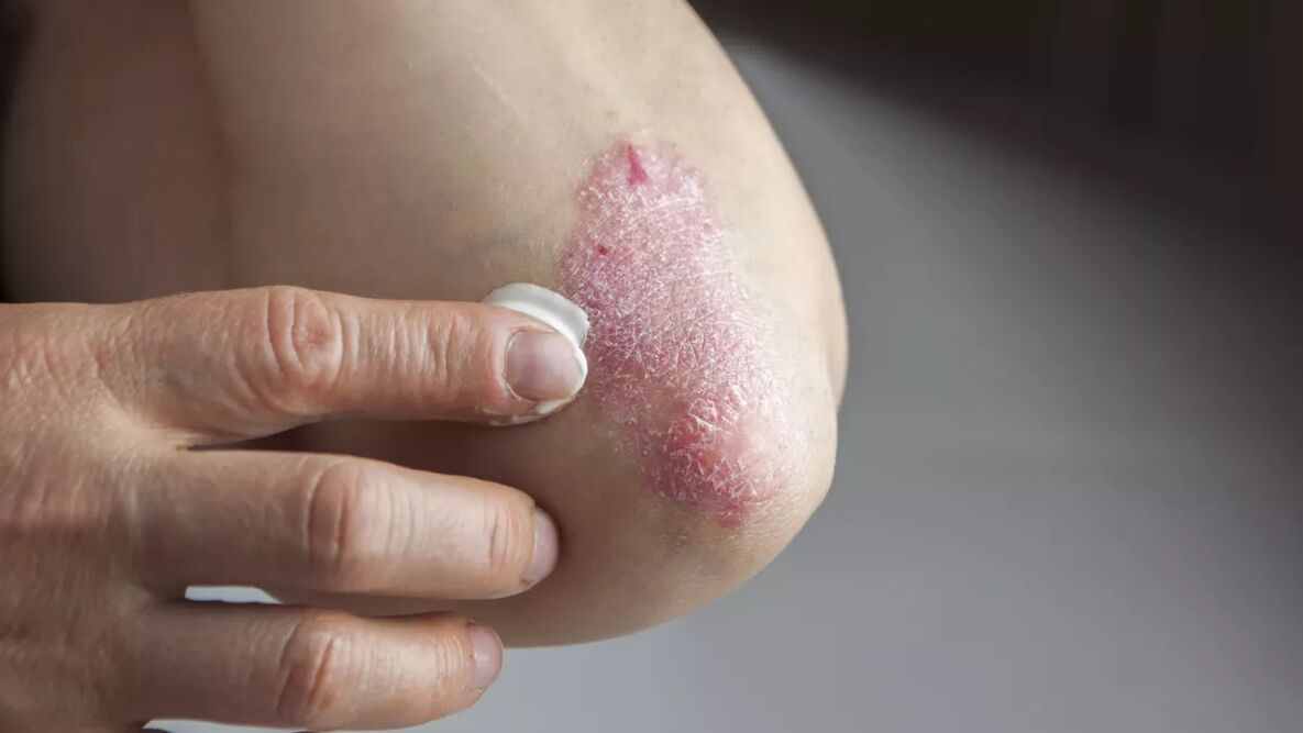 Psoriasis plaques on elbow treated with medical cream