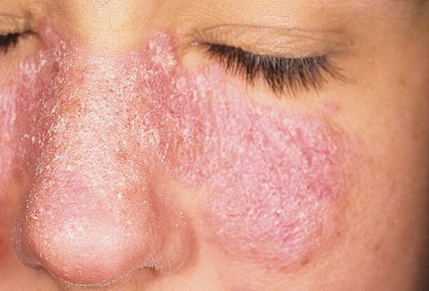 Progressive stage of psoriasis on the facial skin
