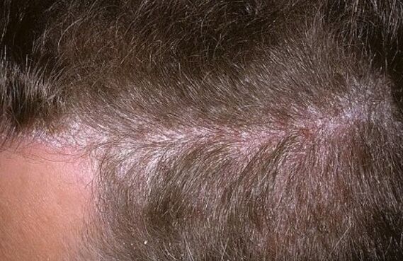 Psoriasis on the head