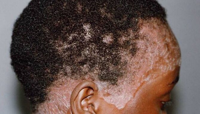 Psoriasis on the head