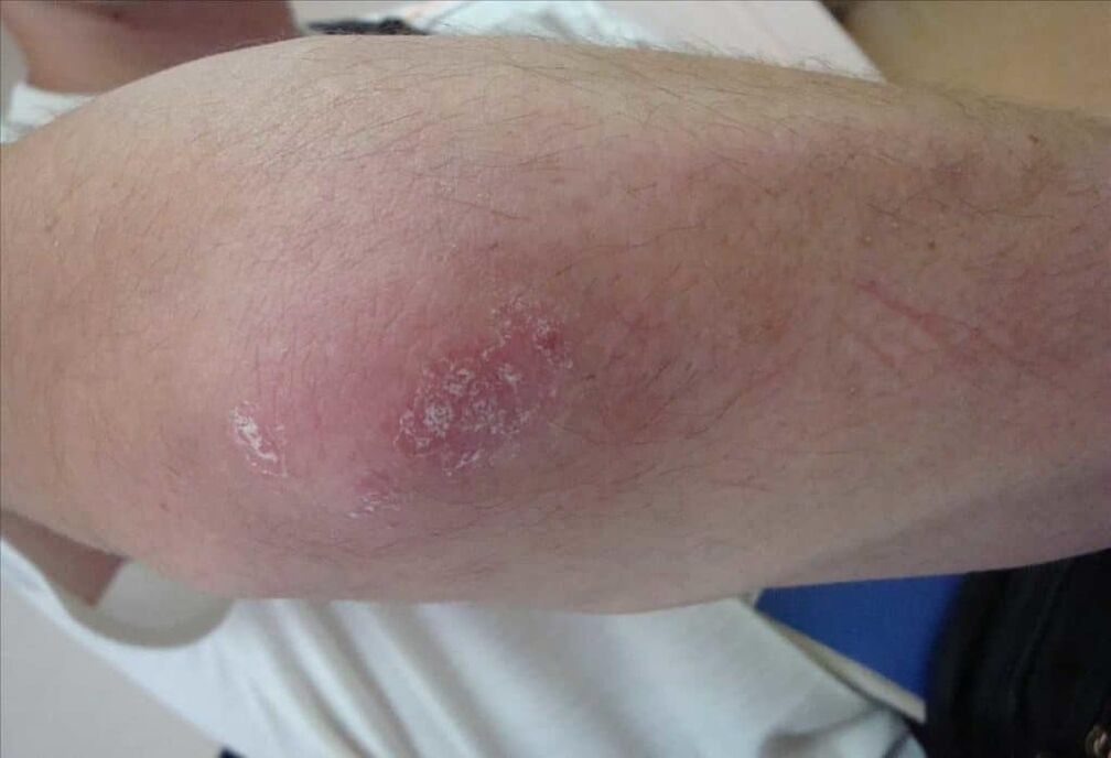 What psoriasis looks like