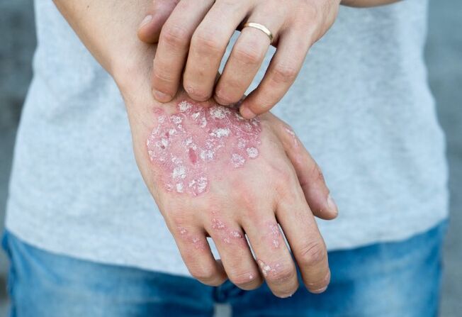 Mesprichered psoriasis
