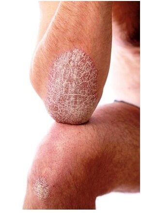 Psoriasis on the Ellbogen