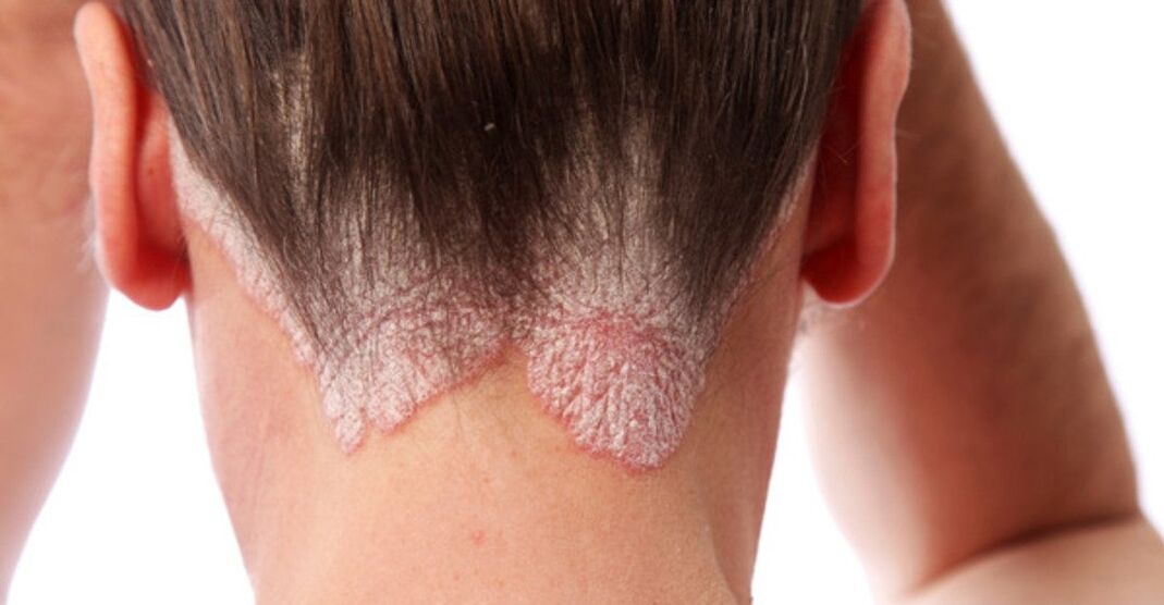Psoriasis on the girl's head