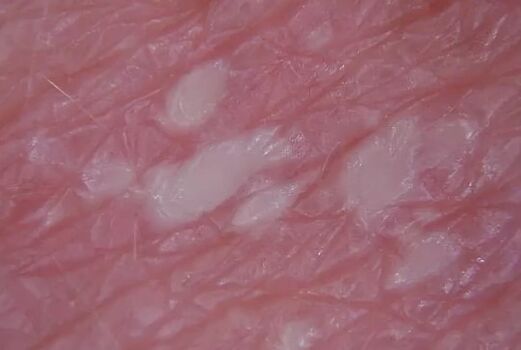 Pustulies psoriasis