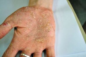 Psoriasis in their palm