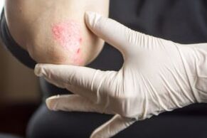 Psoriasis on the Ellbogen