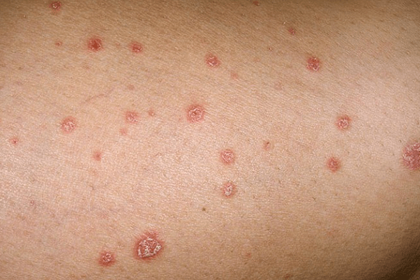 Psoriasis plaques
