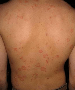 Plaque psoriasis