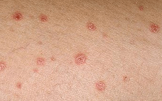 Psoriasis in the early stages