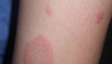 How does the initial stage of psoriasis manifest itself