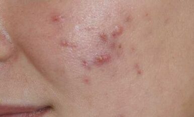 Symptoms of the initial stage of psoriasis