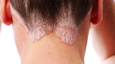 Psoriasis plaques on the scalp