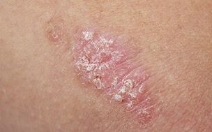 Causes of psoriasis