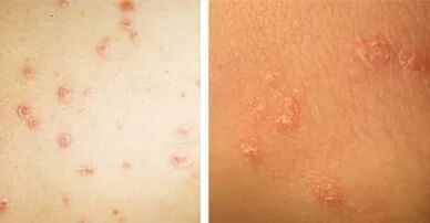 Main symptoms of psoriasis