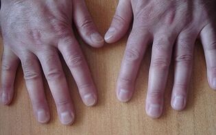 Symptoms of psoriasis in the early stages