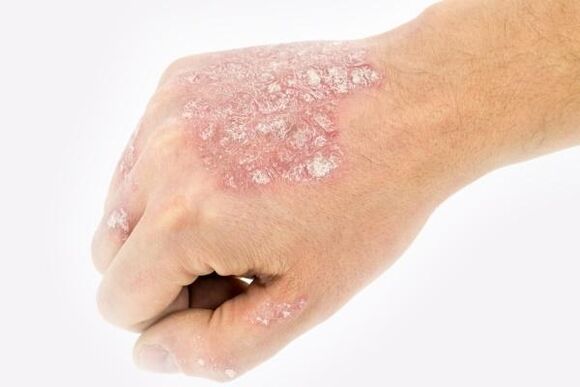Mechanism of development of psoriasis on the hands