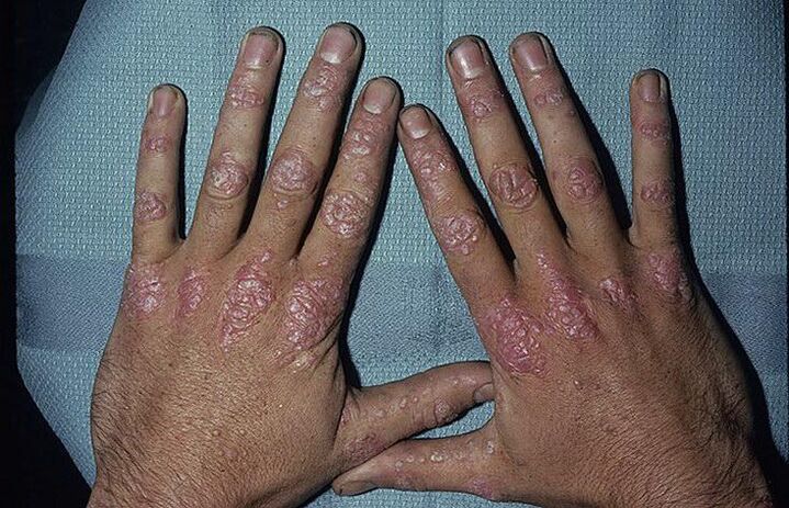 Reasons for developing psoriasis on the hands
