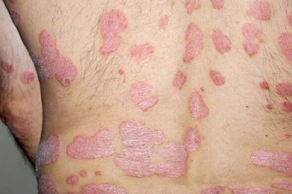 Progressive stage of the papules