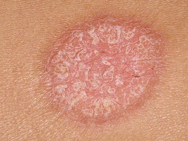 Stationary stage of the papules