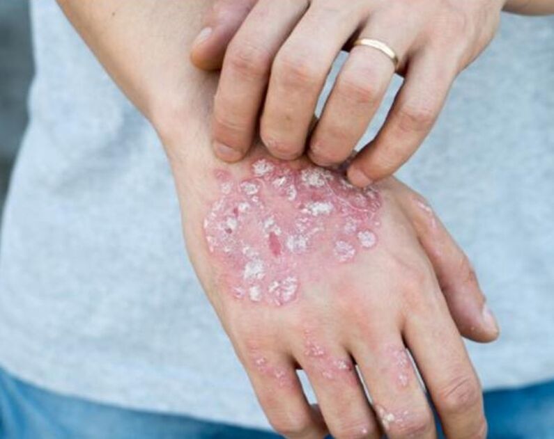 Psoriasis on a man's hands