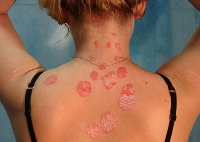Psoriasis in the neck and back