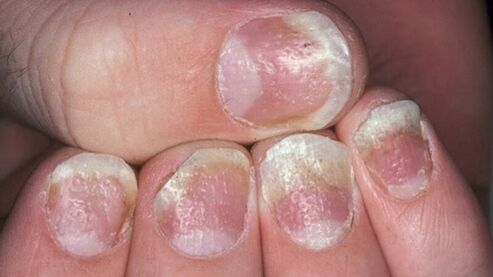 Psoriasis on nails