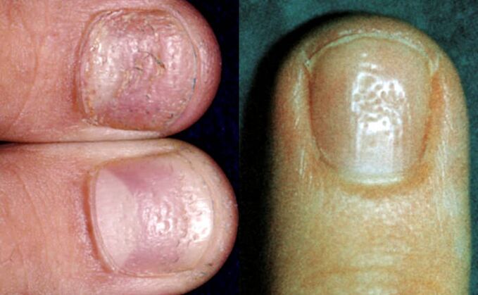 Foxglove symptom - multiple depressions on the surface of the nail plate