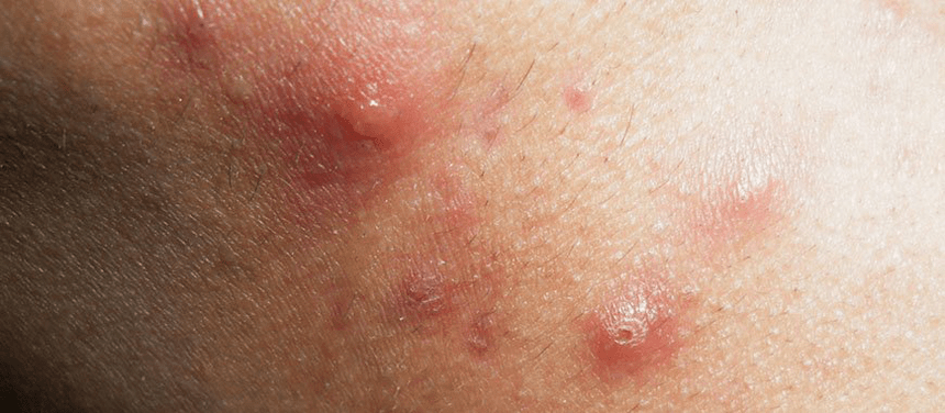 the beginning of the development of good psoriasis in childhood